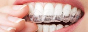 blanchiment-dentaire-eclaircissement1-2y217hi3p3s3rkwjqsj7cw